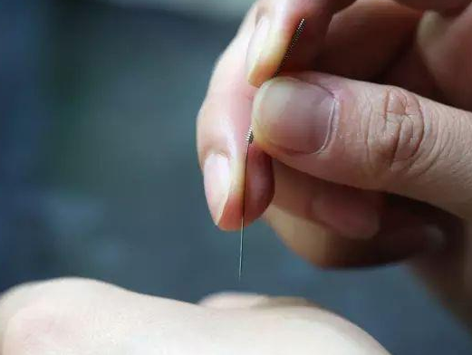 三棱針療法治療高燒嗎？